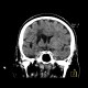 Occlusion of middle cerebral artery, MCA, collateral flow, postischemic changes: CT - Computed tomography